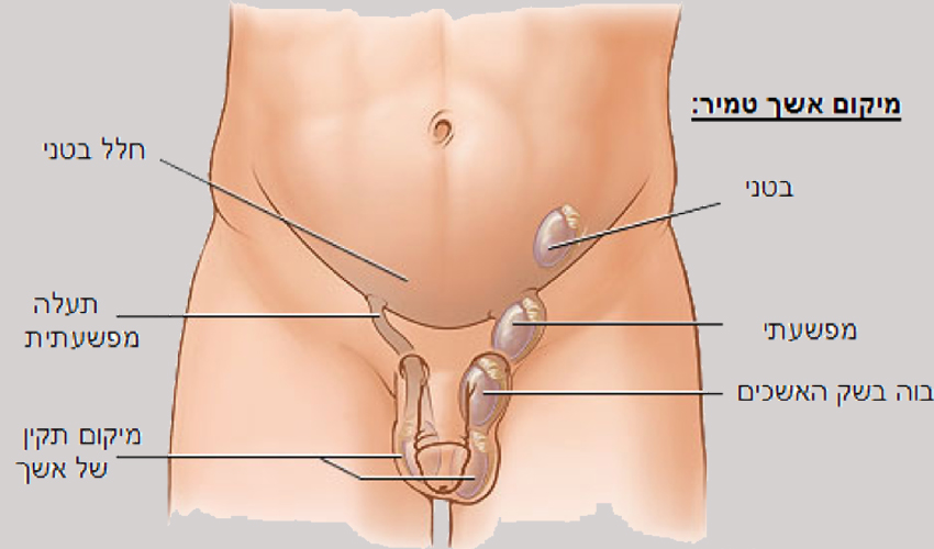 קיבוע אשכים לילדים