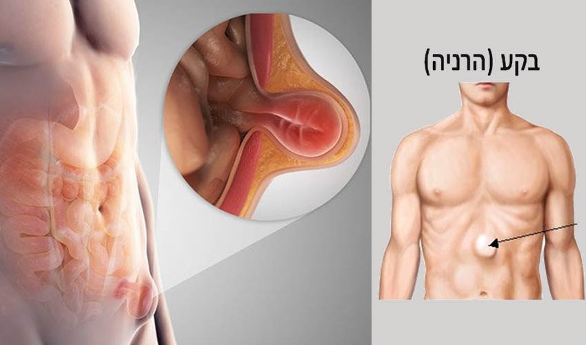 הרניה (בקעים) למיניהם